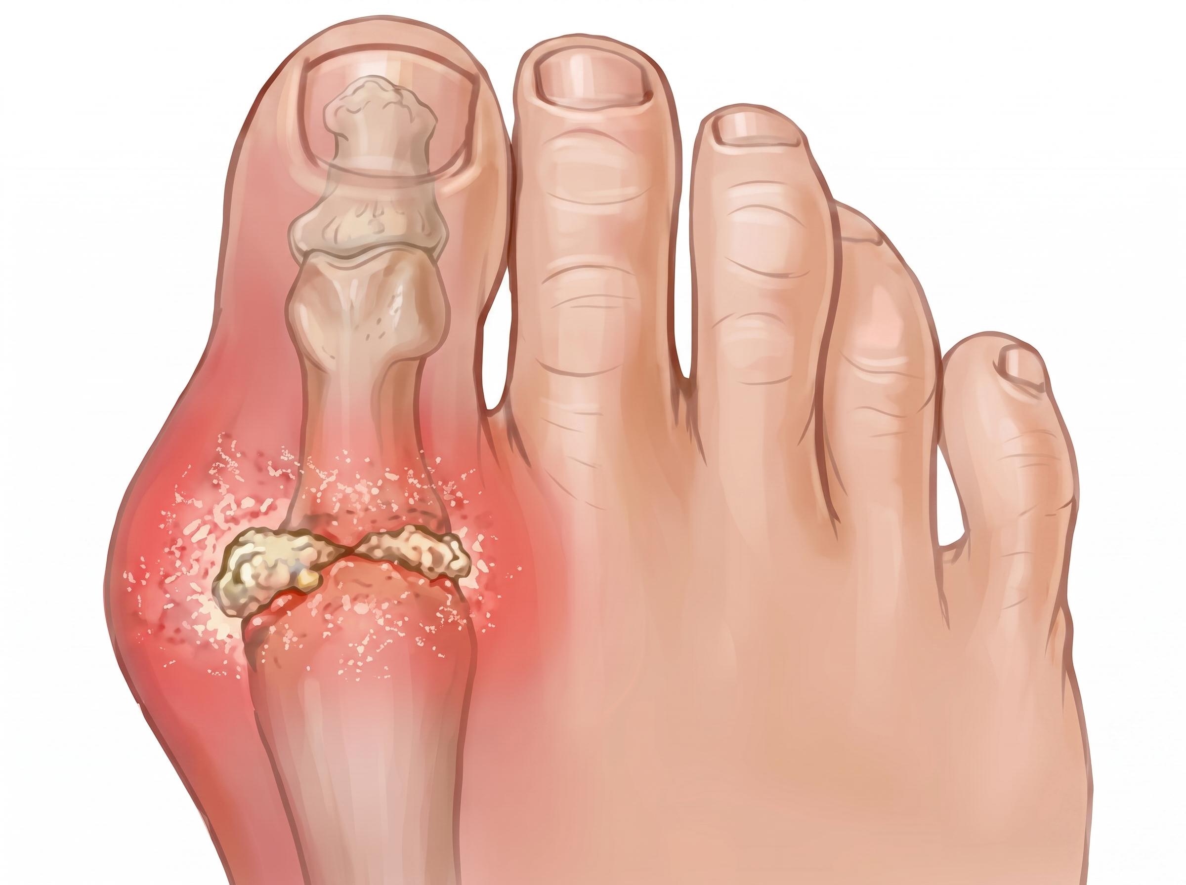 Gout
Sudden severe  joint pain due to uric acid crystallization at small joints.