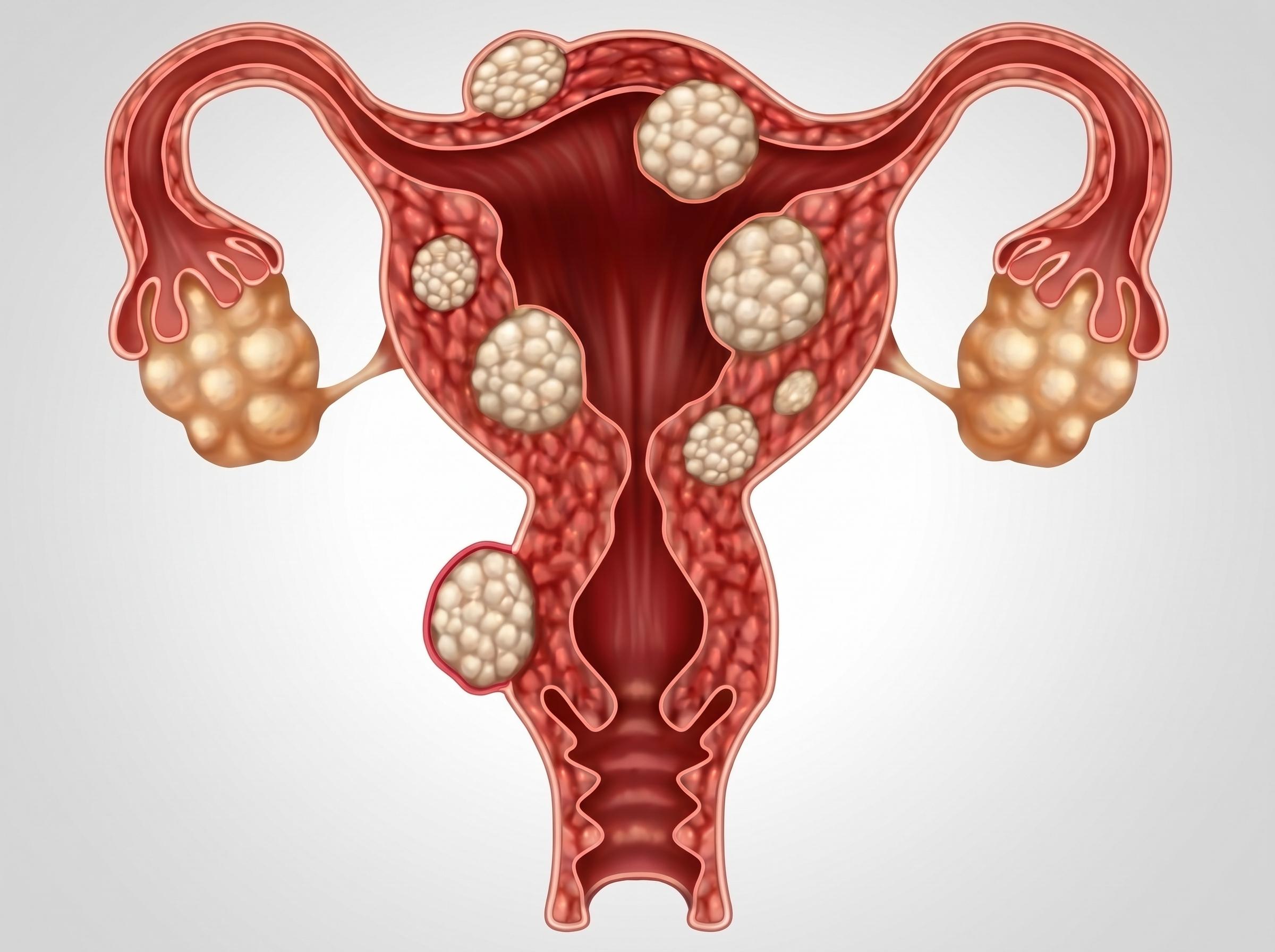 Endometriosis
Chronic pelvic pain and infertility